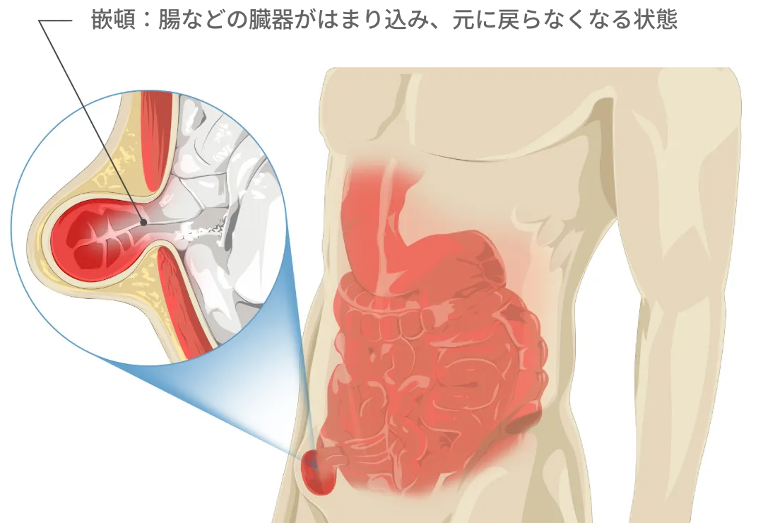 鼠径ヘルニアの嵌頓（かんとん）状態のイラスト